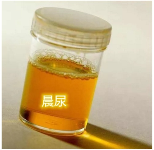 晨尿和随机尿 晨尿:早晨起床后,第一次排出的尿液.