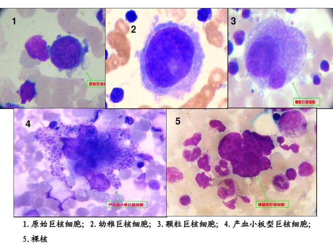 原始巨核细胞;2.幼稚巨核细胞;3.颗粒巨核细胞;4.