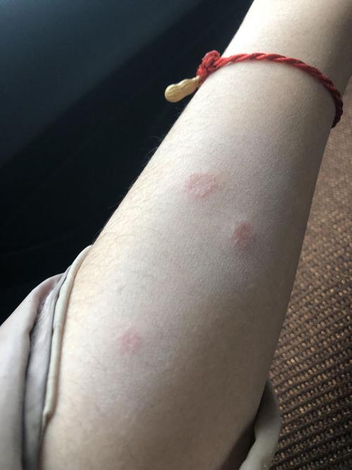 人得猫藓了越长越多