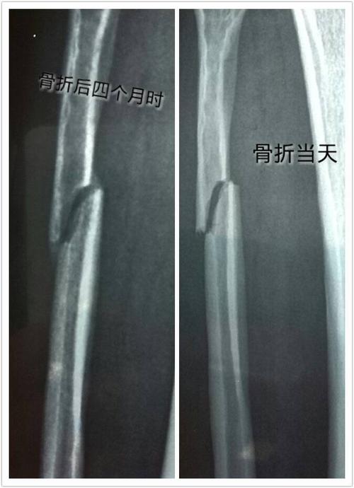 骨折四个月了,骨头还没愈合,有没有必要动手术上钢板