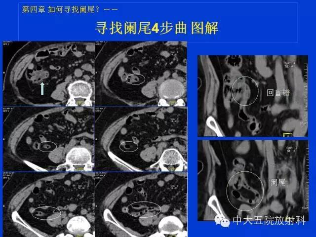 【经典之作】正常阑尾和阑尾炎的ct表现