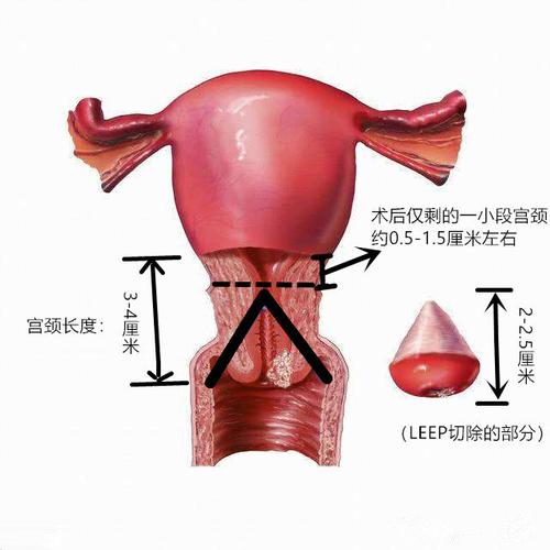 leep锥切术的优缺点