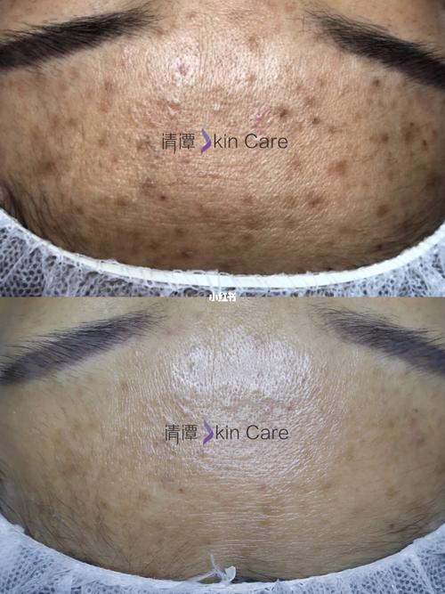 这种就是黑色痘印.它是由于痘痘炎症后,黑色素异常的