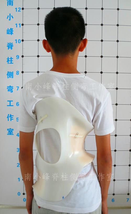 德国根辛根支具分型体系治疗河南14岁脊柱侧弯孩子一例报告