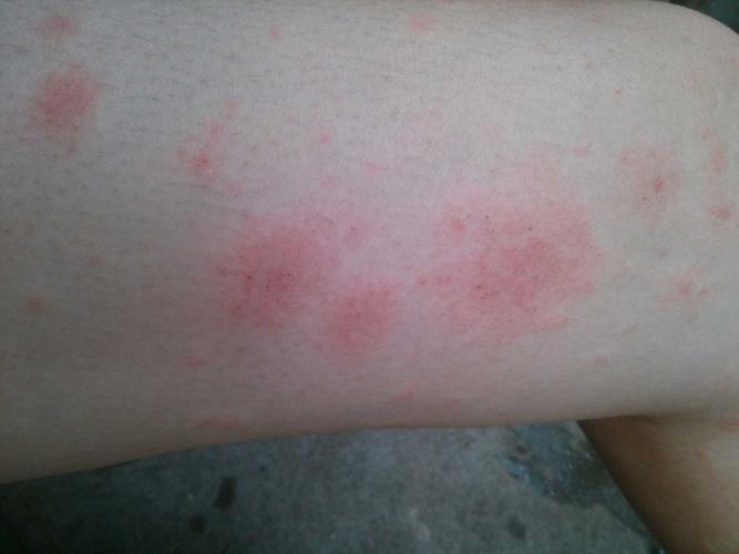 年轻白领皮肤异常没在意,却被确诊艾滋病,险些错过最佳治疗期