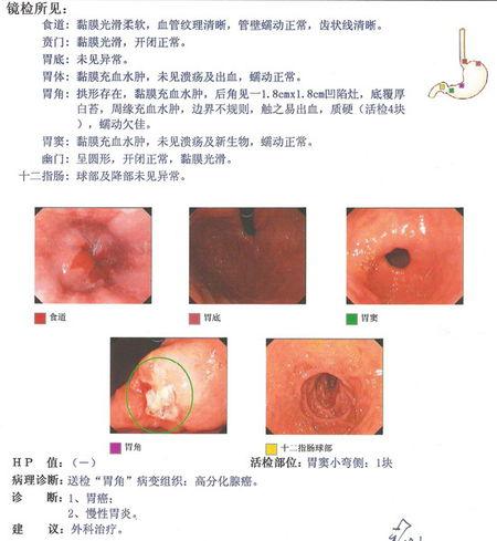 胃角的中分化腺癌