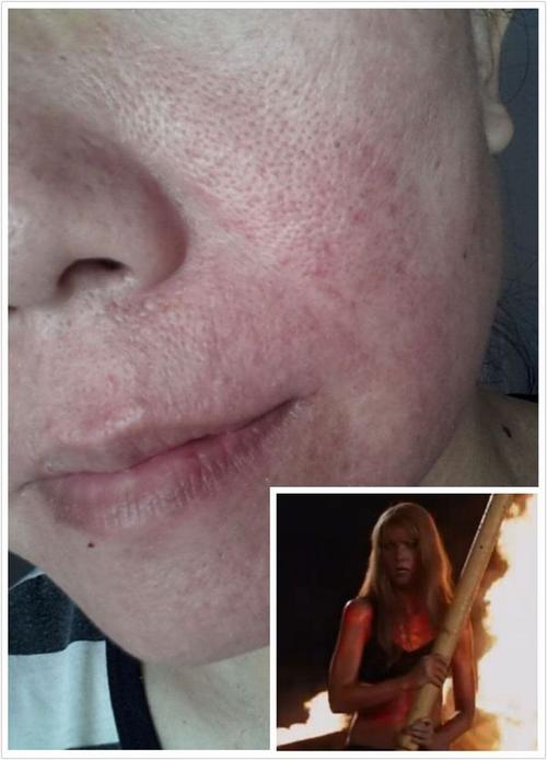 一,什么是激素脸?