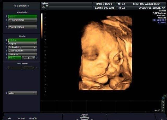 四维时看到宝宝在咧嘴笑孕妇很高兴