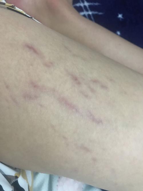 大腿根部最近长了好多紫色纹路!大神告知是什么回事,而且越来越多