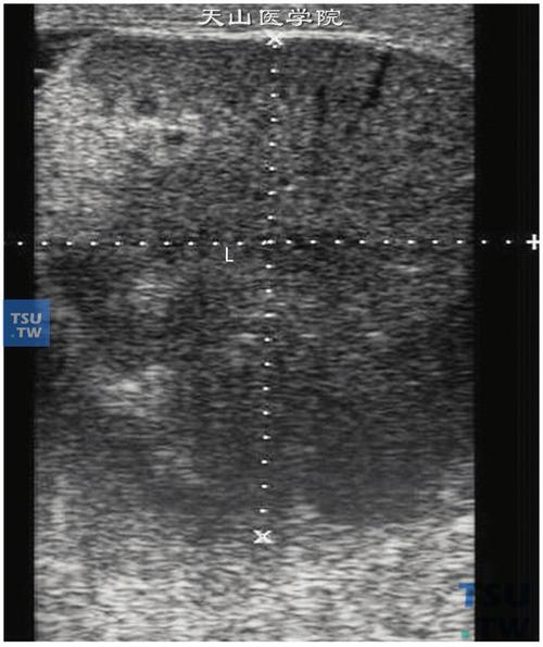 睾丸炎症病理图谱