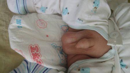 问:宝宝小鸡鸡右侧有鼓起来的肿块,是不是哭的太厉害形成的疝气?