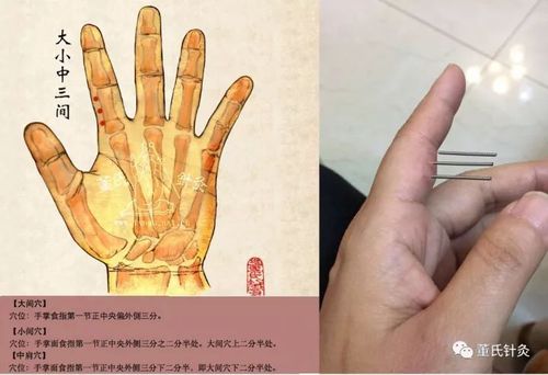 董氏针灸林正泰案例分享之前列腺处方穴