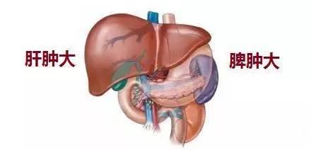 脾大不一定就是肝硬化但脾大引发的危害不容小觑