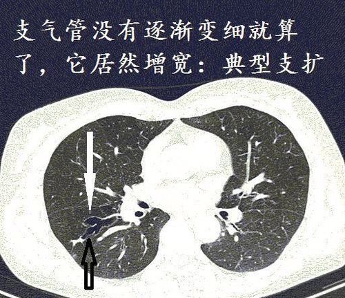 经典图谱,详细解说支气管扩张ct小诀窍!学不会我拜你为师!
