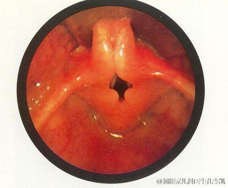 宝宝为何出现公鸡打鸣声—喉软化症
