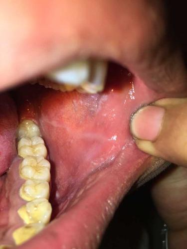 有没有知名医生懂扁平苔藓和口腔白斑.