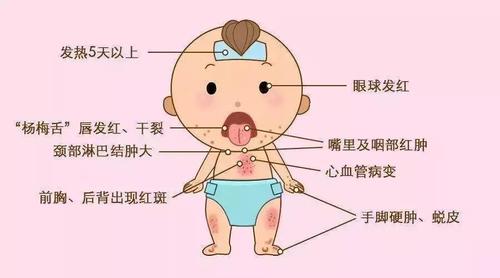 【中医有话说】最近频发猩红热,家长看到这三大症状要