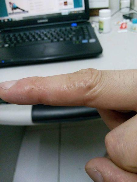 问:麻烦专家帮忙看看这是真菌感染还是湿疹呢?有时很痒