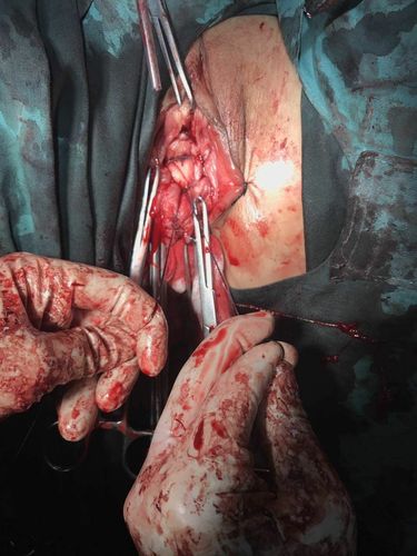 榆林一院病例分享-子宫脱垂行阴式全子宫切除术 阴道残端骶棘韧带悬吊