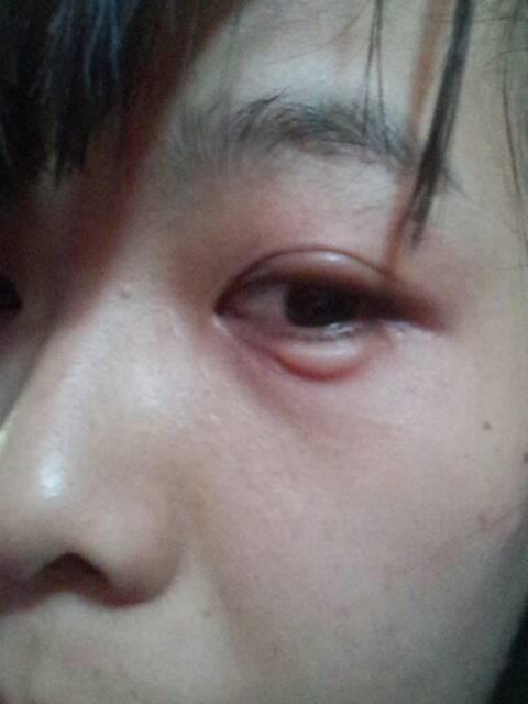 收拾旧物时,眼睛突然肿了,以为是进了汗水,哪知道原来