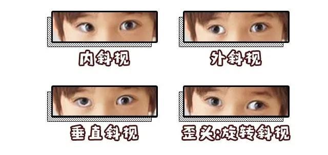 实用科普儿童斜视怎么办爱尔眼科医生为您支招