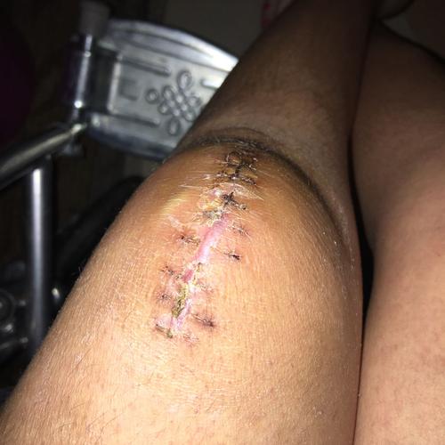 髌骨骨折术后37天锻炼弯的时候有块白的东西鼓起来,这