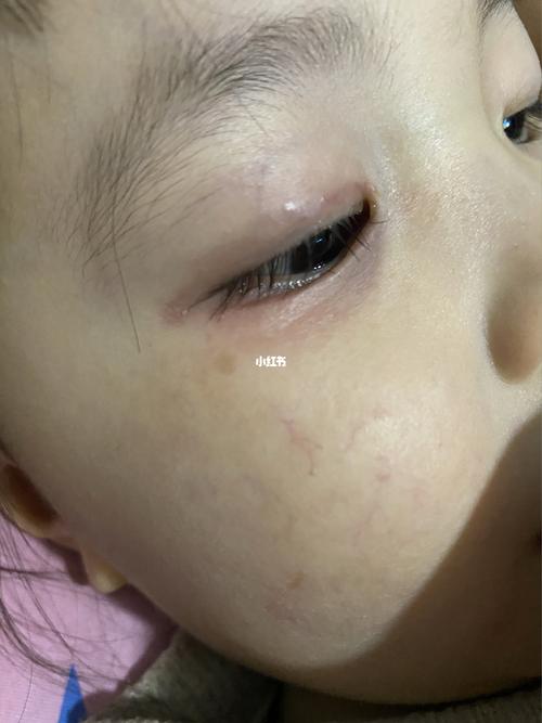 我姑娘和泪囊炎战斗的第三个年头,终于摆脱湿湿的眼睛