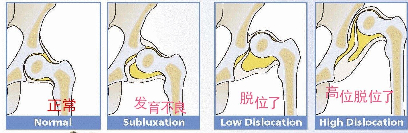 先天性髋关节脱位为什么好发于小孩子身上治疗最重要是这一点