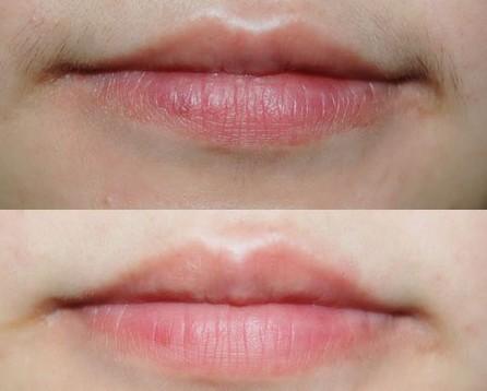 不过在做激光脱 激光脱唇毛前后对比 咨询:激光脱唇毛几次可以脱干净