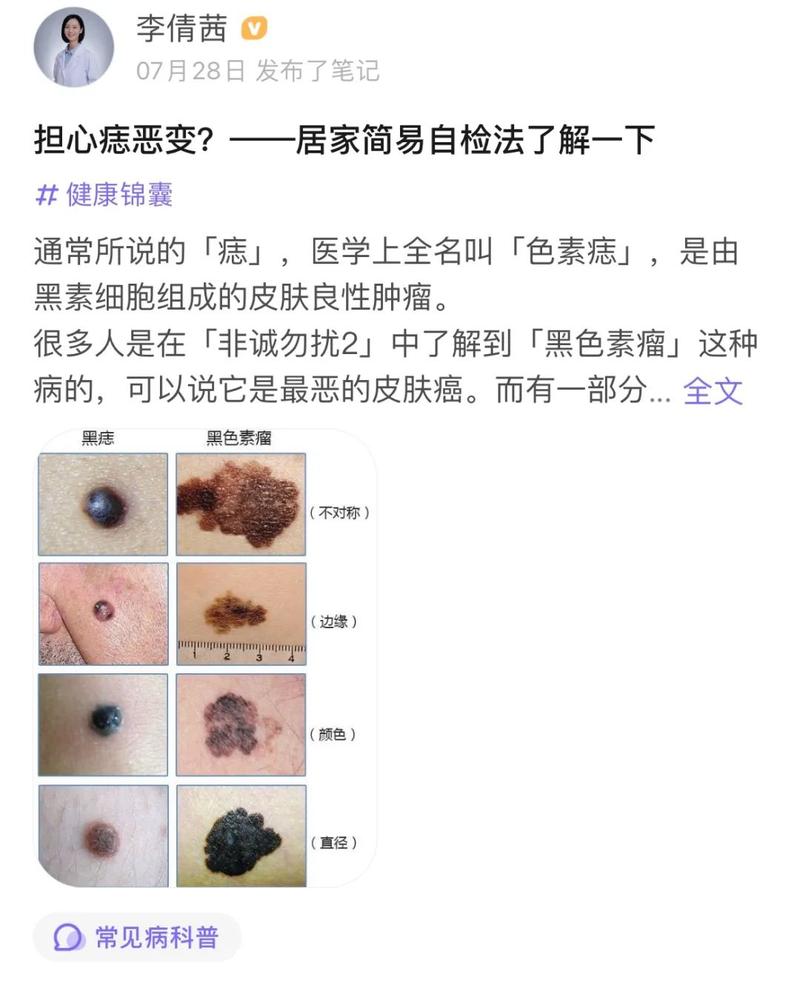 "痣"有这5种特征可能会恶变,一旦发现要当心