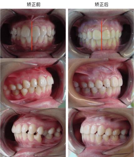 成人拔牙矫正 | 牙齿拥挤,中线偏移,咬合错乱等多种问题