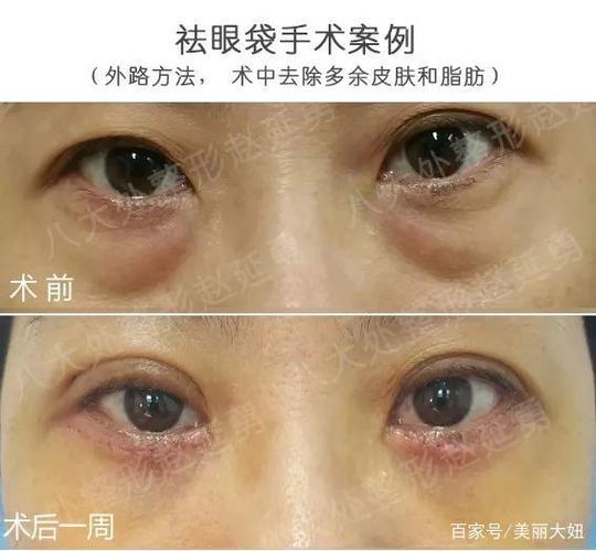 祛眼袋手术后会出现下睑外翻是真的吗能修复吗