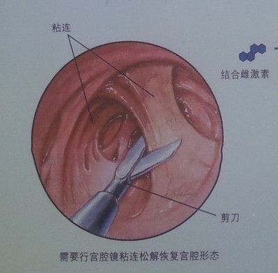 宫颈粘连的临床表现 女性朋友需要了解