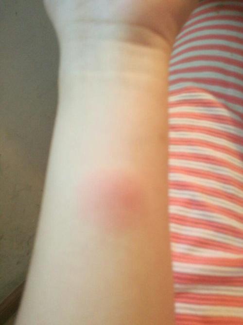 我的肺结核皮试红肿了,是阳性吗