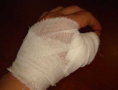 伤的是手掌就这样包