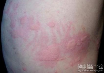 去医院检查,开始的时候说就是一般的过敏,后来换了家医院,说是荨麻疹