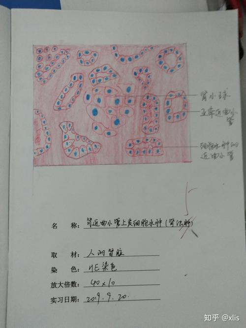 肾近曲小管上皮细胞水肿肾浊肿红蓝铅笔手绘