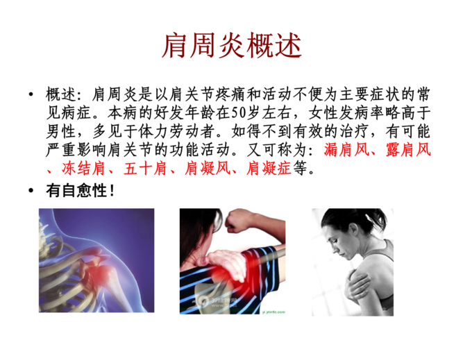 肩周炎的防治及功能锻炼ppt18页