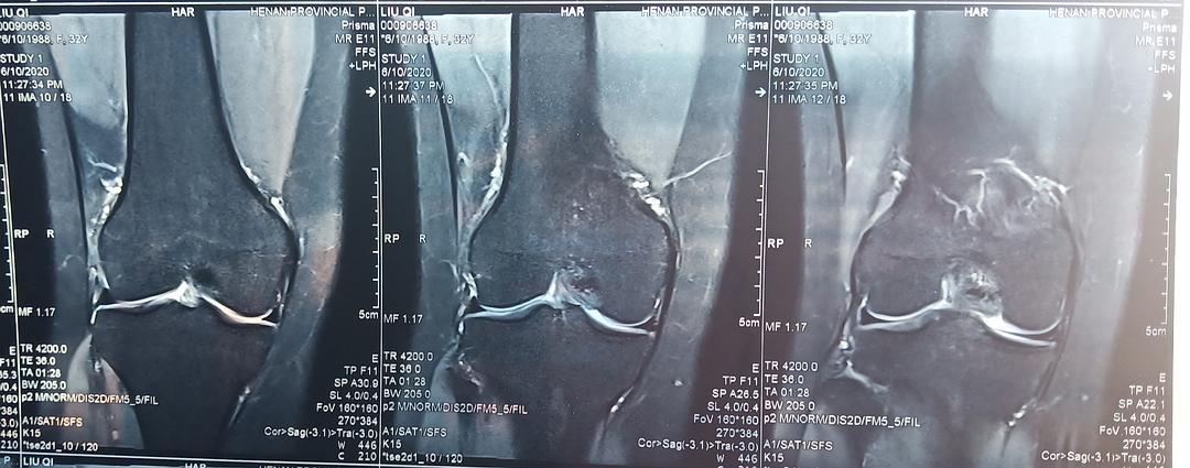 膝关节核磁共振读片