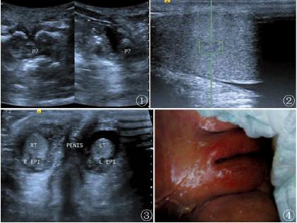 图2睾丸的剪切波值测量;图3双侧睾丸及阴茎回声;图4患儿女性外阴表现