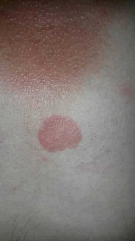 问:我这两年胸前长了和圆形红斑,不痛不痒,颜色有时深有时浅.