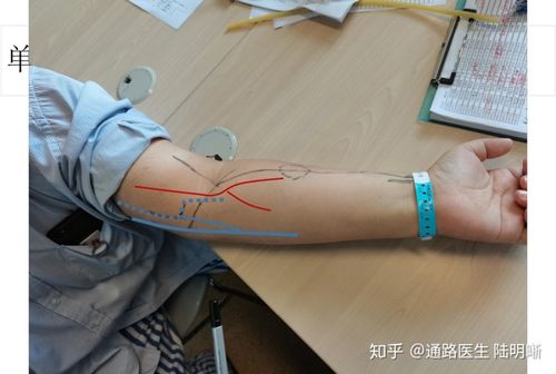 肱静脉走行变异&"孤独"的肱动脉