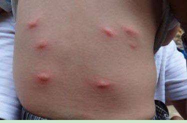 疥疮是由人型疥螨寄生于人体皮肤表层内引起的慢性传染性皮肤病,本病