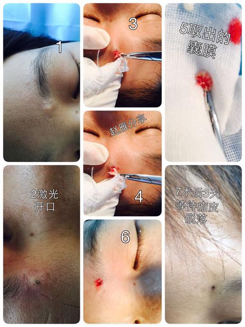 350人已读分享一个我们微创治疗皮脂腺囊肿的激光手术,我们对传统的