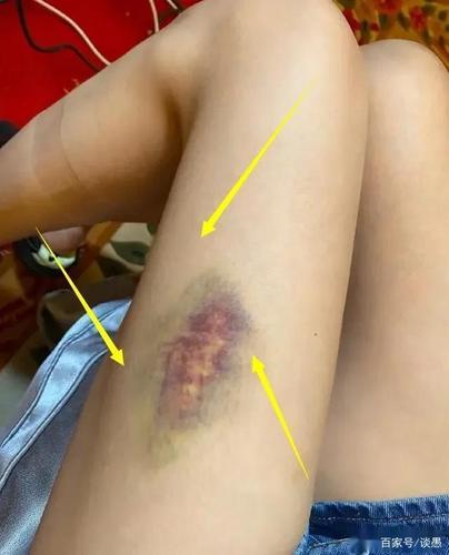 沈梦辰受伤了,腿部大片淤青!却被质疑"卖惨"