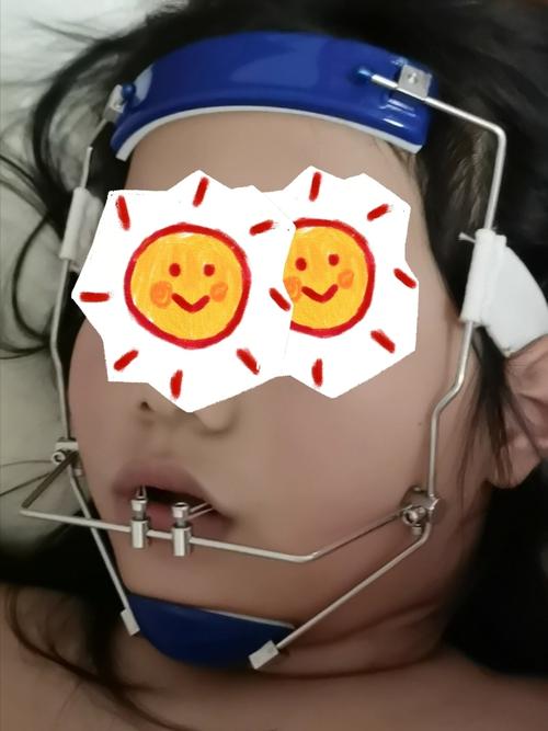 地包天牙齿矫正第二周记录_牙齿矫正_牙医_面具_大宝怎么样_工作_美妆