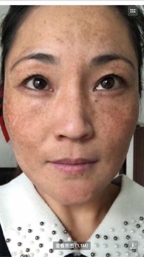 黄褐斑治疗案例