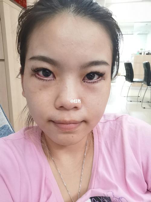 终于去割眼袋了 ,外切(第一天)_眼袋_护士_疤痕_顺产