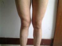 我想确定是x退,还是膝内翻或者膝外翻?