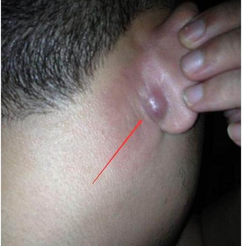 在耳朵后面耳垂,软骨与头颅之间的位置长有这种小包,千万要当心了.
